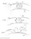 Fig. 06 - METHOD AND APPARATUS FOR TRANSPORT OF SUBSTANCES INTO BODY TISSUE