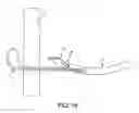 Fig. 18 - Method and apparatus for passing suture through tissue
