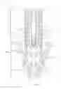 Fig. 06 - Sutureless vascular anastomosis connection