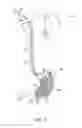 Fig. 02 - Method and apparatus for treating obesity and controlling weight gain using self-expanding intragastric devices