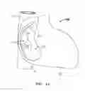 Fig. 02 - Wire-Like and Other Devices for Treating Septal Defects and Systems and Methods for Delivering the Same