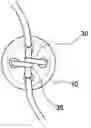 Fig. 01 - Adjustable suture-button construct for ankle syndesmosis repair
