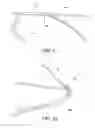 Fig. 06 - Adjustable suture-button construct for ankle syndesmosis repair