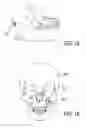 Fig. 10 - Bone implant and systems that controllably releases silver