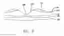 Fig. 07 - Visual prosthesis with an improved electrode array adapted for foveal stimulation