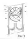 Fig. 07 - Flow-deflecting medical device