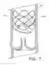 Fig. 08 - Flow-deflecting medical device