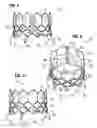 Fig. 02 - Prosthetic heart valve