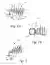 Fig. 02 - Ossicular prosthesis having helical coil