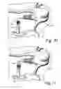 Fig. 07 - Ossicular prosthesis having helical coil