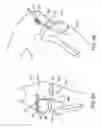 Fig. 06 - Canine ligament bone anchor and method