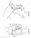 Fig. 09 - Canine ligament bone anchor and method