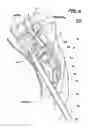 Fig. 06 - Methods and apparatus for performing therapeutic procedures in the spine