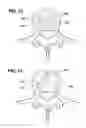 Fig. 09 - Methods and apparatus for performing therapeutic procedures in the spine