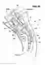 Fig. 33 - Methods and apparatus for performing therapeutic procedures in the spine