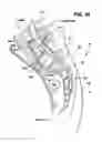 Fig. 35 - Methods and apparatus for performing therapeutic procedures in the spine