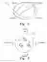 Fig. 04 - Implantable patella component having a thickened superior edge