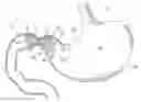 Fig. 01 - Pyloric obesity valve