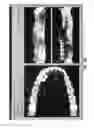 Fig. 05 - Custom orthodontic appliance forming method and apparatus