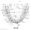 Fig. 08 - Custom orthodontic appliance forming method and apparatus