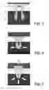 Fig. 03 - Method for disassembling an arrangement