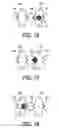 Fig. 10 - Valve with material having modifiable degree of penetrability