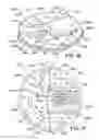 Fig. 11 - High yield ladle bottoms