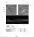Fig. 03 - 3D retinal disruptions detection using optical coherence tomography