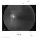 Fig. 04 - 3D retinal disruptions detection using optical coherence tomography