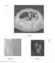 Fig. 06 - Method for determining an estimation of a topological support of a tubular structure and use thereof in virtual endoscopy