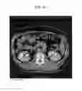 Fig. 11 - METHOD AND SYSTEM UTILIZING ITERATIVE RECONSTRUCTION WITH ADAPTIVE PARAMETERS FOR COMPUTER TOMOGRAPHY (CT) IMAGES
