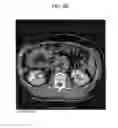 Fig. 12 - METHOD AND SYSTEM UTILIZING ITERATIVE RECONSTRUCTION WITH ADAPTIVE PARAMETERS FOR COMPUTER TOMOGRAPHY (CT) IMAGES