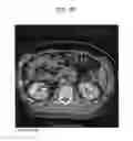 Fig. 14 - METHOD AND SYSTEM UTILIZING ITERATIVE RECONSTRUCTION WITH ADAPTIVE PARAMETERS FOR COMPUTER TOMOGRAPHY (CT) IMAGES