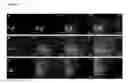 Fig. 05 - Cellular seeding and co-culture of a three dimensional fibroblast construct