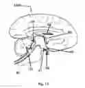 Fig. 17 - AUTISM TREATMENT