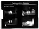 Fig. 01 - MAXILLOFACIAL BONE AUGMENTATION USING RHPDGF-BB AND A BIOCOMPATIBLE MATRIX