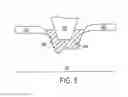 Fig. 04 - Implant pellets and methods for performing bone augmentation and preservation