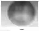 Fig. 02 - Agent for preventing and treating pityriasis versicolor