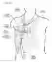 Fig. 97 - METHODS AND DEVICES TO DECREASE TISSUE TRAUMA DURING SURGERY