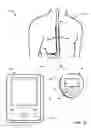 Fig. 02 - Collecting posture information to evaluate therapy