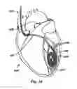 Fig. 35 - Devices, systems, and methods for myocardial infarct border zone reinforcement