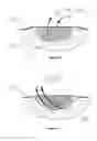 Fig. 22 - In-situ wound cleansing apparatus