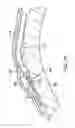 Fig. 16 - Epicardial mapping and ablation catheter