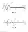 Fig. 09 - Renal denervation catheter with cooled RF electrode