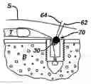 Fig. 01 - Surgical filament snare assemblies