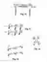 Fig. 04 - Extra-discal intervertebral stabilization device