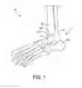 Fig. 02 - Orthopedic surgical guide