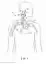 Fig. 02 - Electrode structures and methods for their use in cardiovascular reflex control