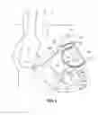 Fig. 02 - Pacing lead for a left cavity of the heart, implanted in the coronary system