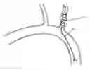 Fig. 01 - METHODS AND APPARATUS FOR TREATING NEUROVASCULAR VENOUS OUTFLOW OBSTRUCTION